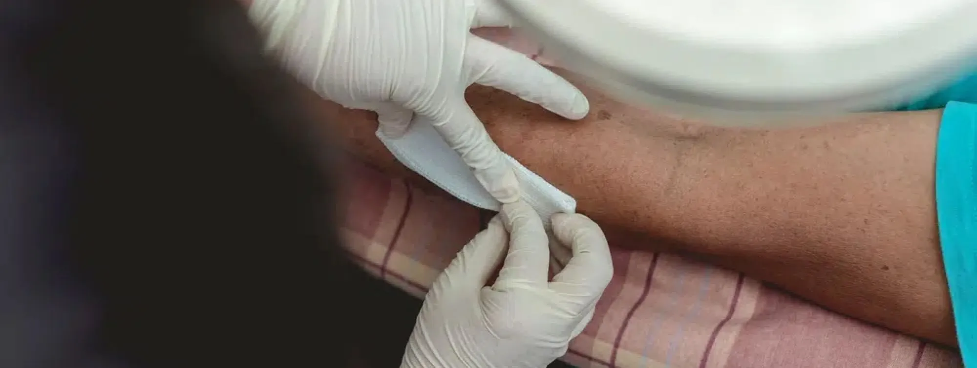 Dog Bite Injury