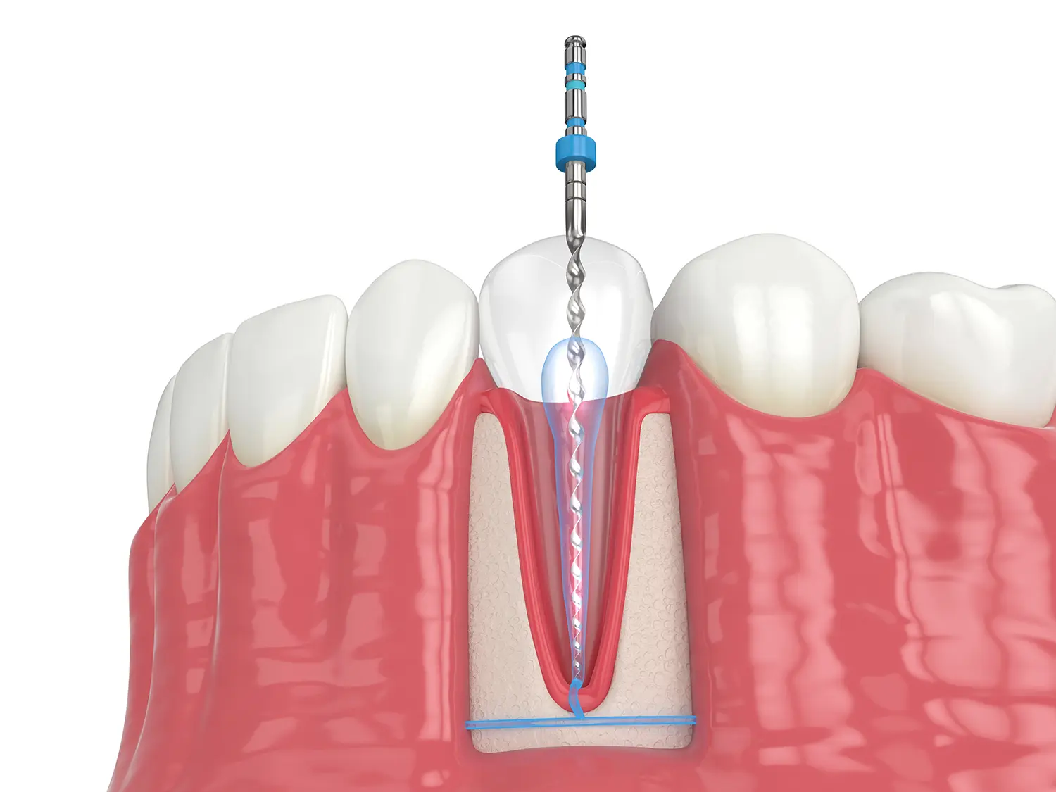 Root Canal Therapy in Vienna, VA | SmileWorx