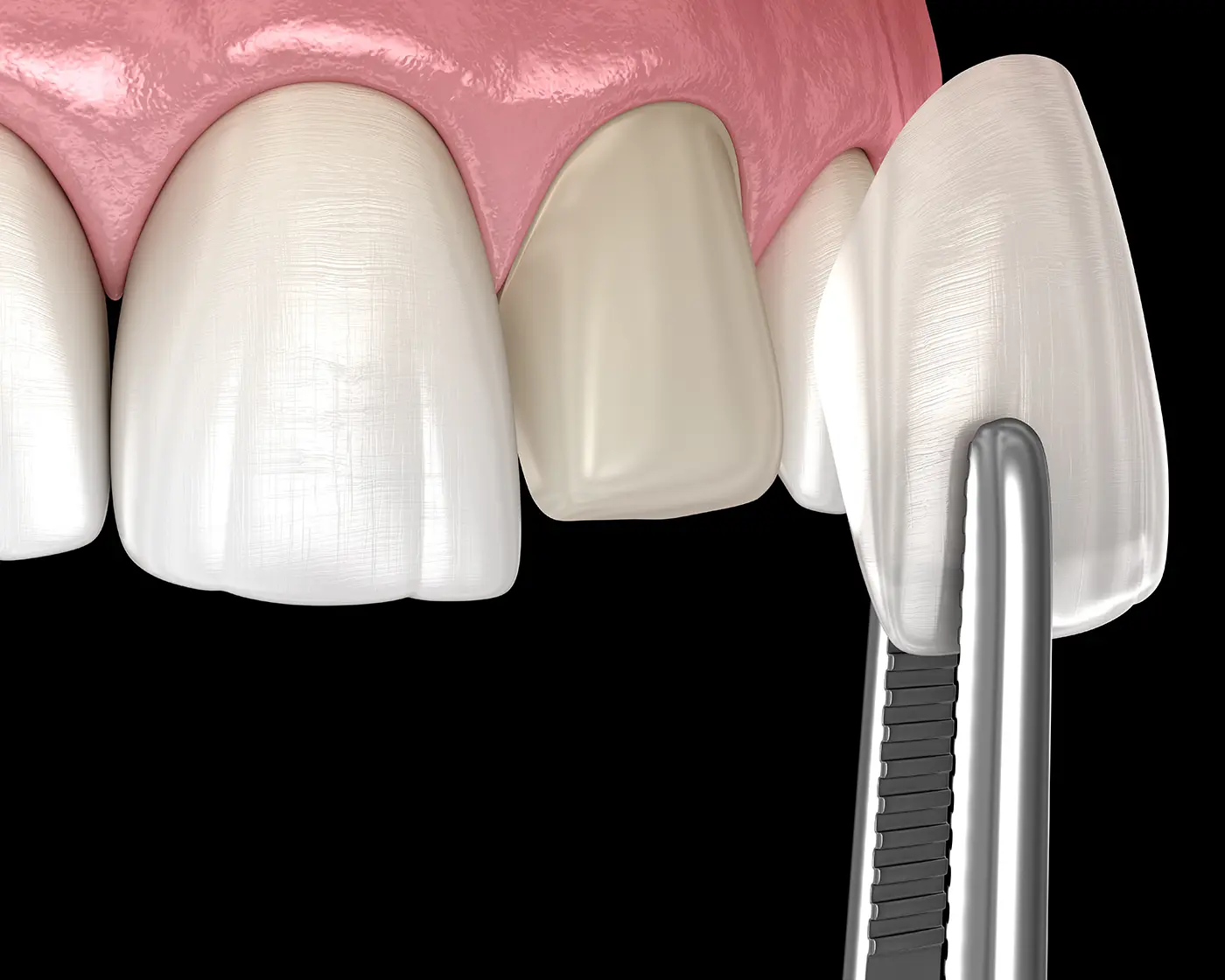 A dental model of a tooth and a dental tool.