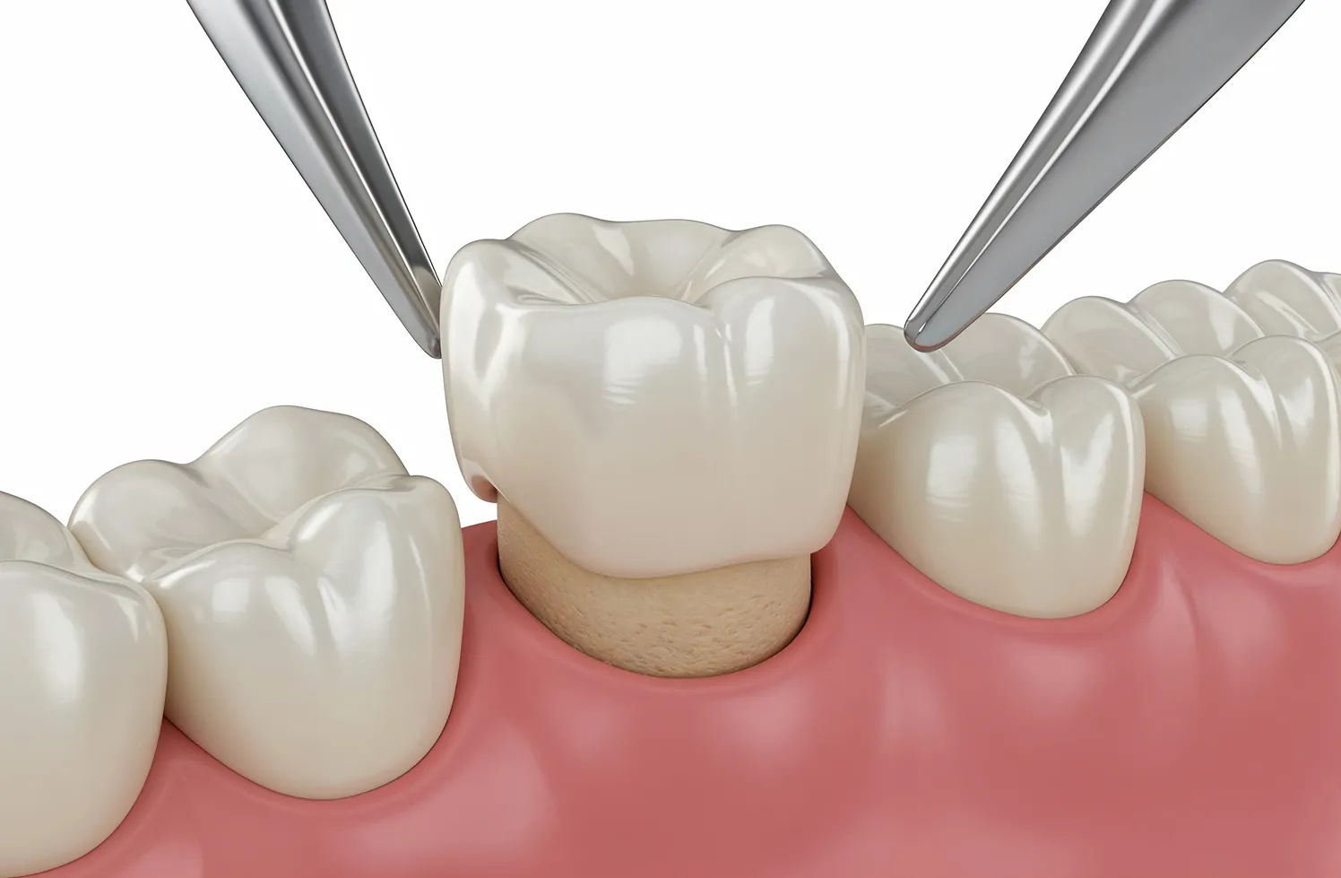 A close up of a tooth fitting a crown 