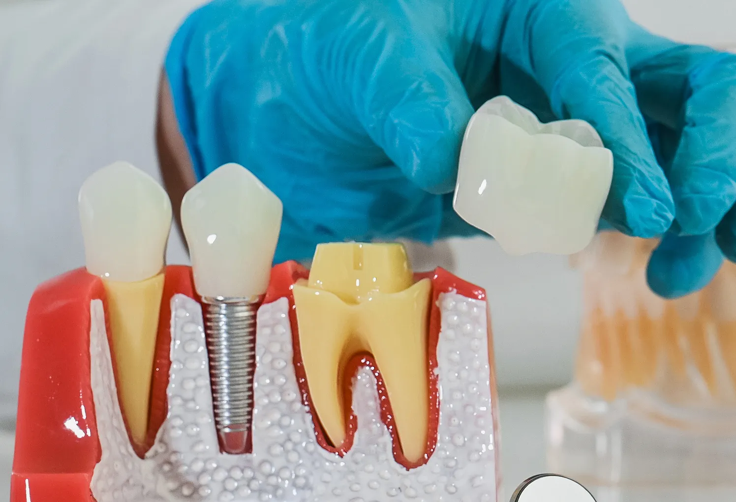 A person in blue gloves and gloves holding a dental model