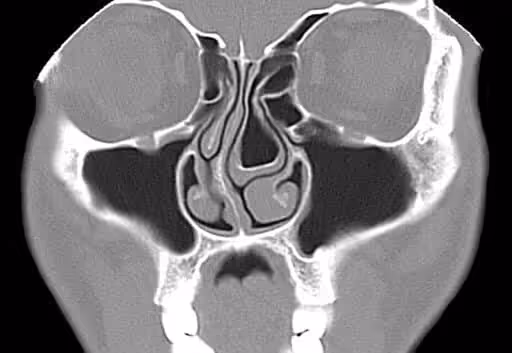 Explicación de Concha Bullosa: causas, síntomas y guía de tratamiento