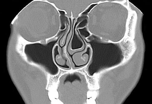 Concha Bullosa Explained: Causes, Symptoms, and Treatment Guide