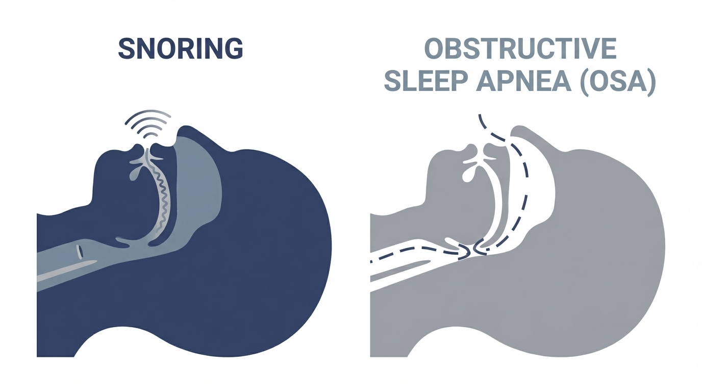 Snoring vs OSA side-by-side panels showing open airway vibration vs narrowed throat with interrupted airflow