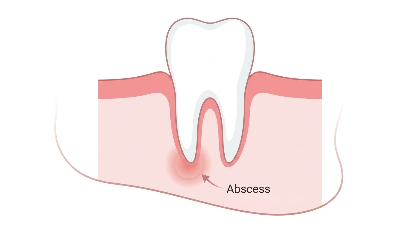 Dental abscess illustration with subtle jawline swelling
