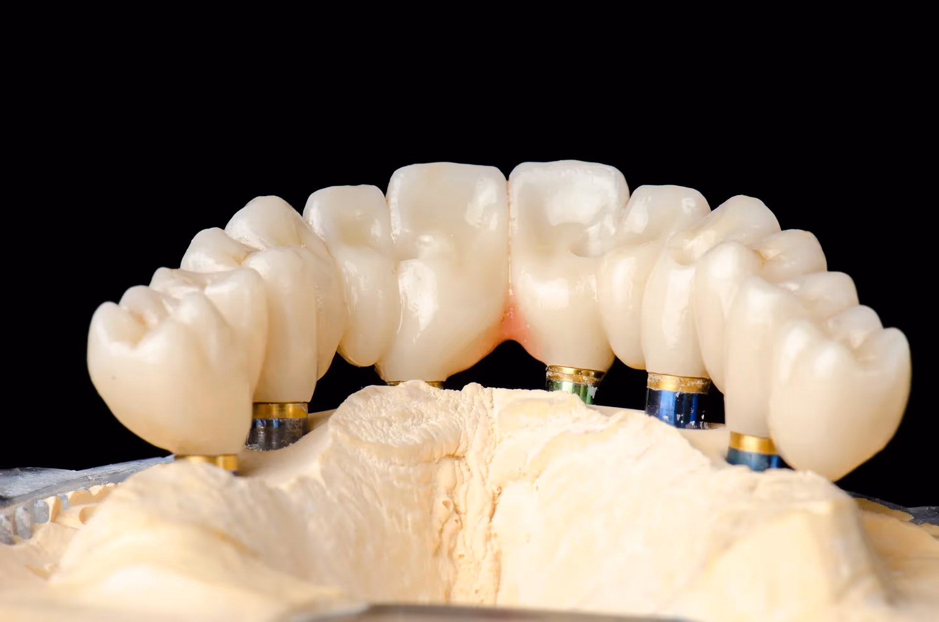 Full-Arch Implant Restorations in Phoenix