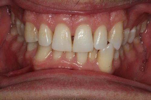 Invisalign SE Calgary - Anterior Before 
