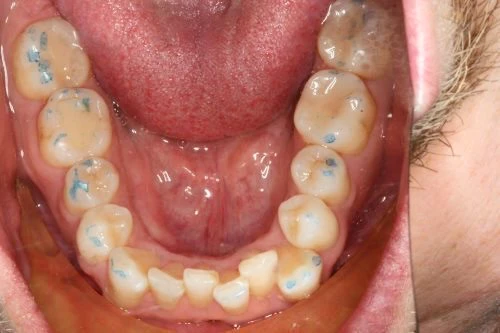 Invisalign SE Calgary - Lower Before 