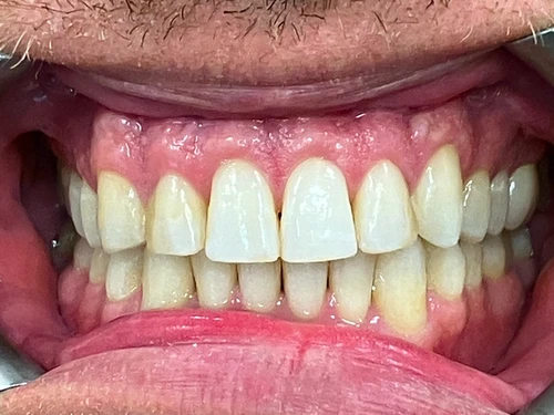 Invisalign SE Calgary - Anterior After 
