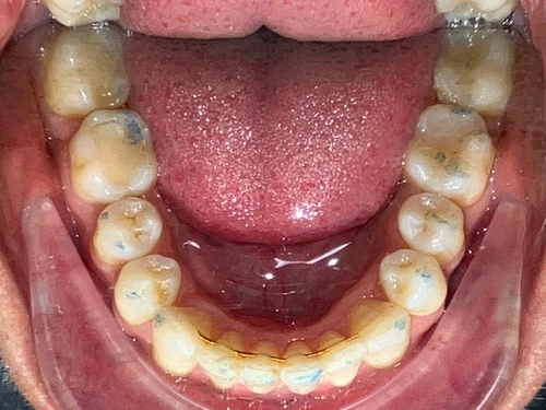 Invisalign SE Calgary - Lower After