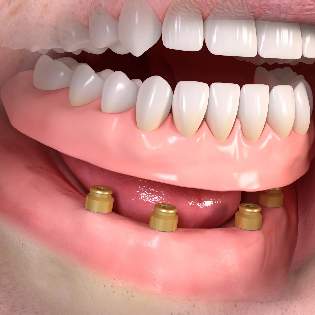 Prothèse amovible qui se clipse sur des attaches fixées à des implants