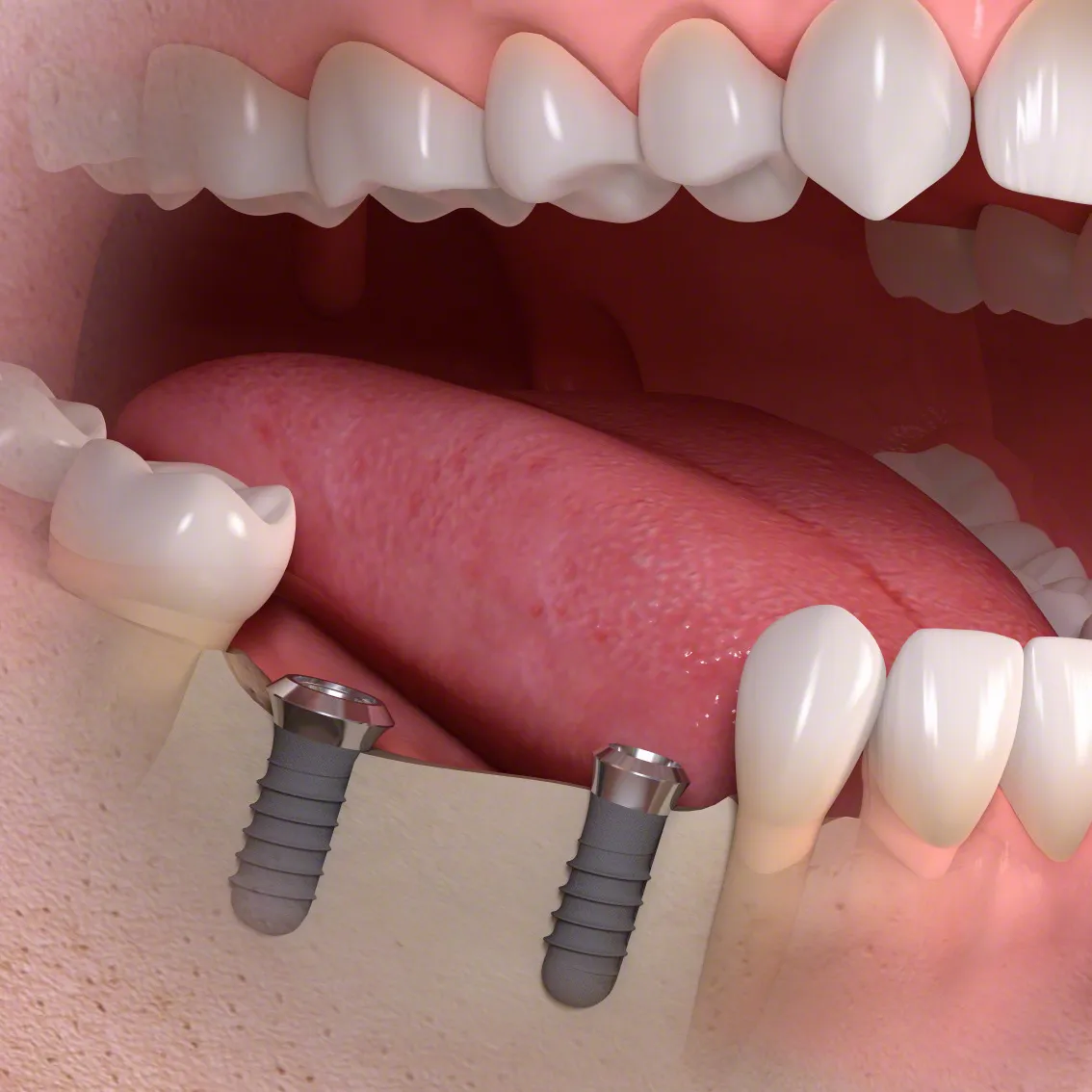 Deux implants prêts à recevoir un bridge