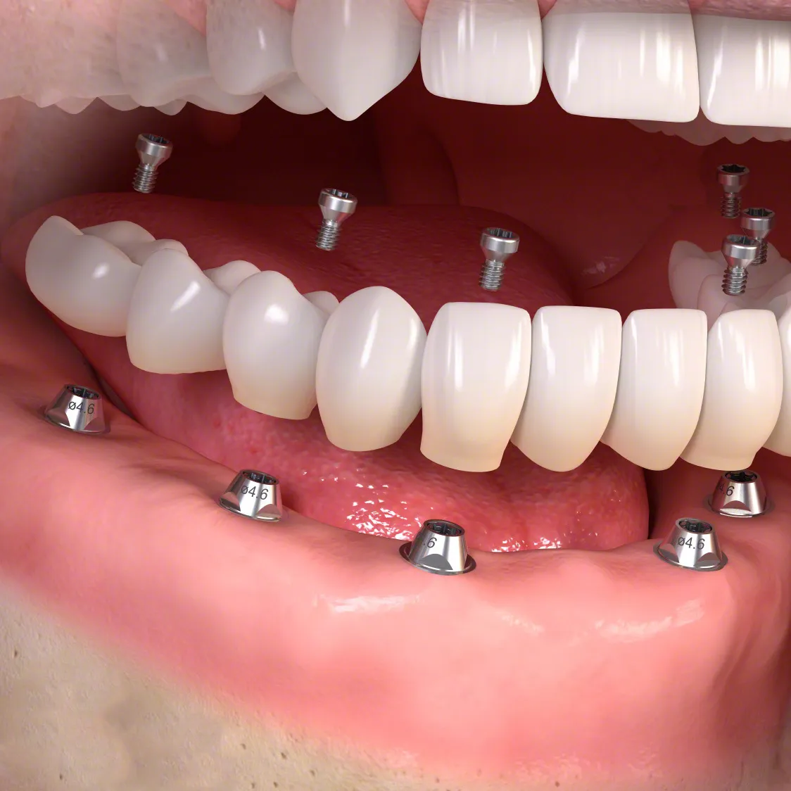 Bridge complet vissé sur plusieurs implants