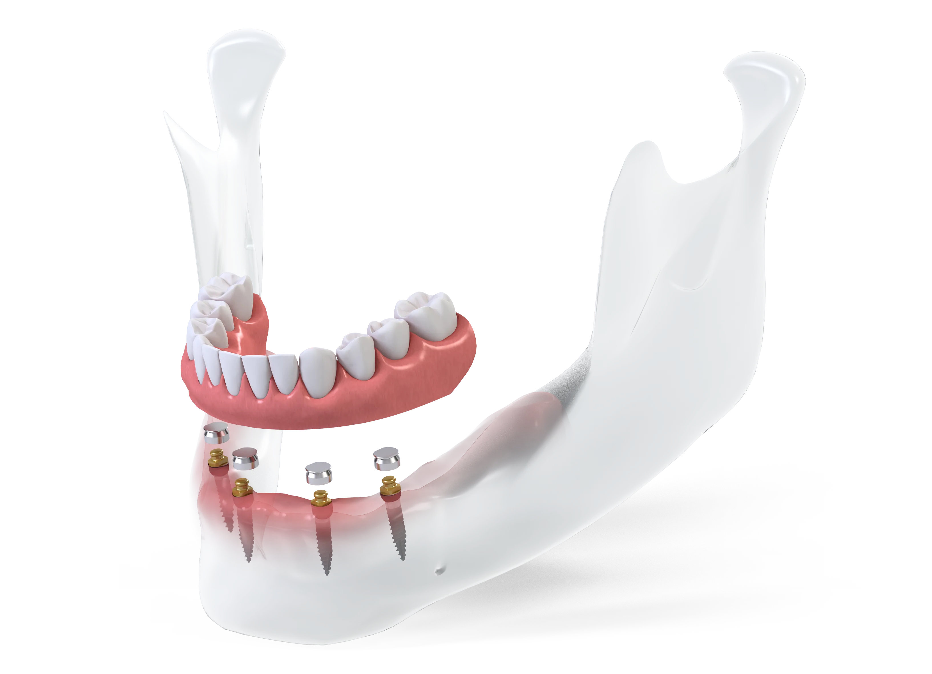 Prothèse amovible du bas qui se clipse sur quatre mini-implants
