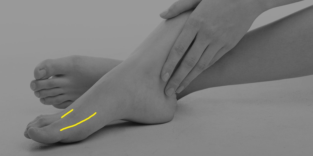 Schnittführung beikonventioneller Hallux-valgus-OP