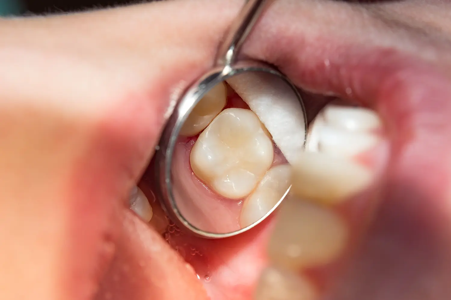 Restorative Dentistry in Valparaiso, IN | Dunes Dental Studio