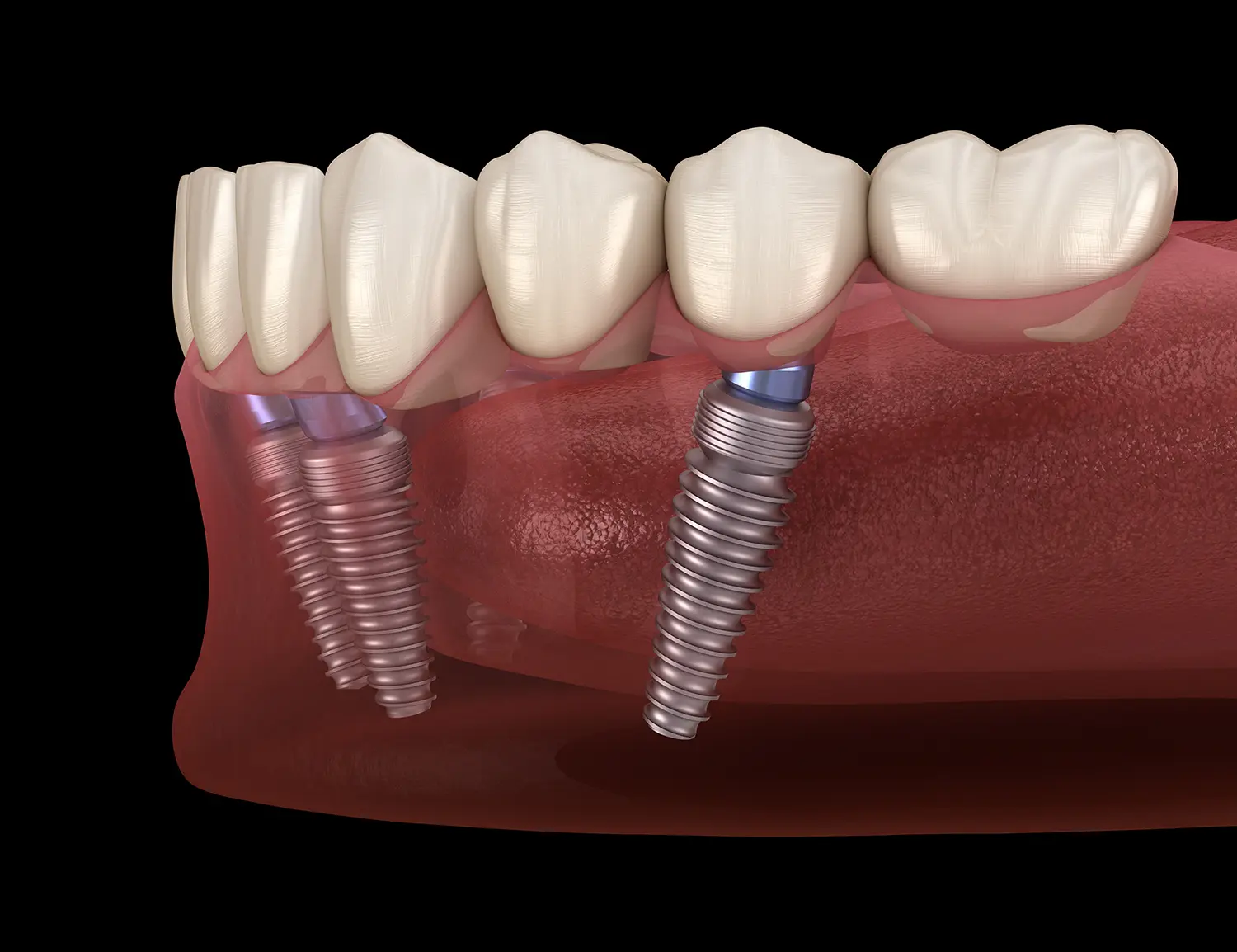 Dental Implants in Valparaiso, IN | Dunes Dental Studio