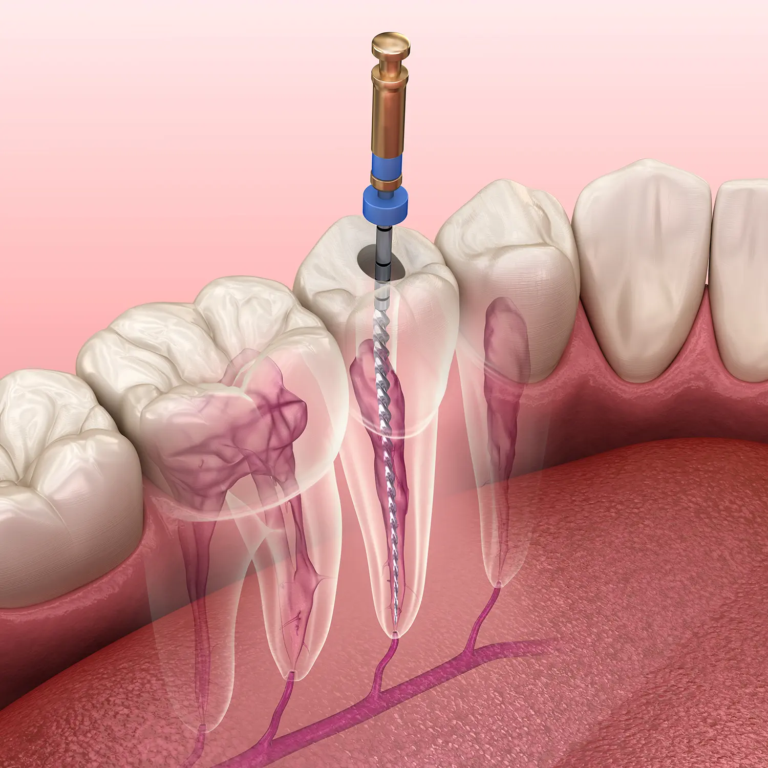 Root Canal Therapy in Valparaiso, IN | Dunes Dental Studio