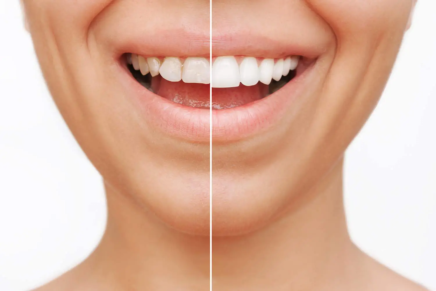 Smile Makeovers in Valparaiso, IN | Dunes Dental Studio