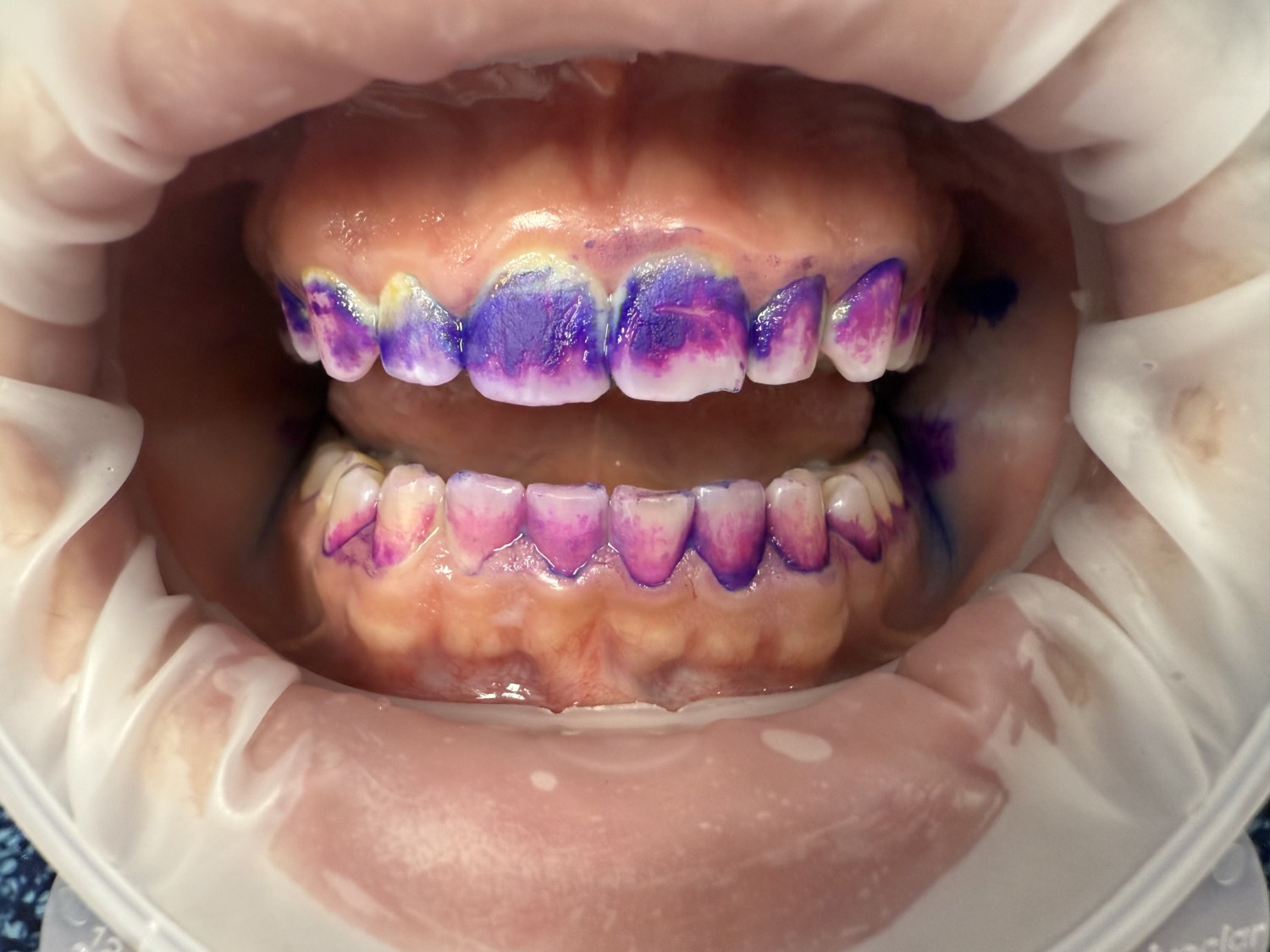 Guided Biofilm Therapy in Valparaiso, IN | Dunes Dental Studio