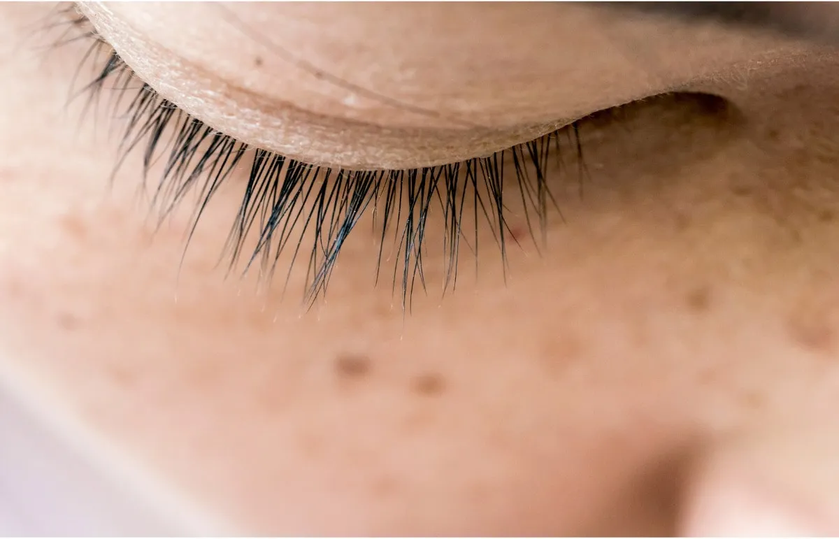 What You Need to Know About Melasma