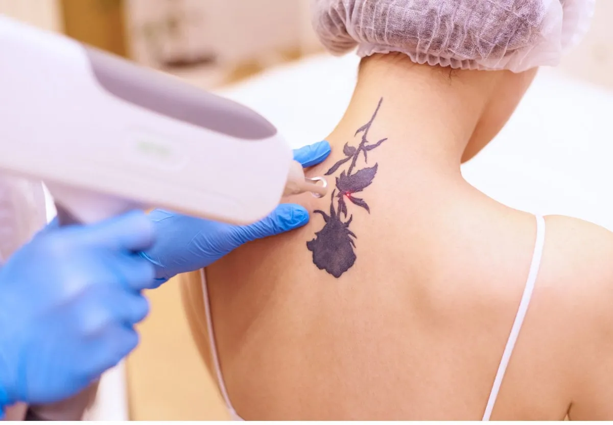 Winter Is The Ideal Time For Tattoo Removal