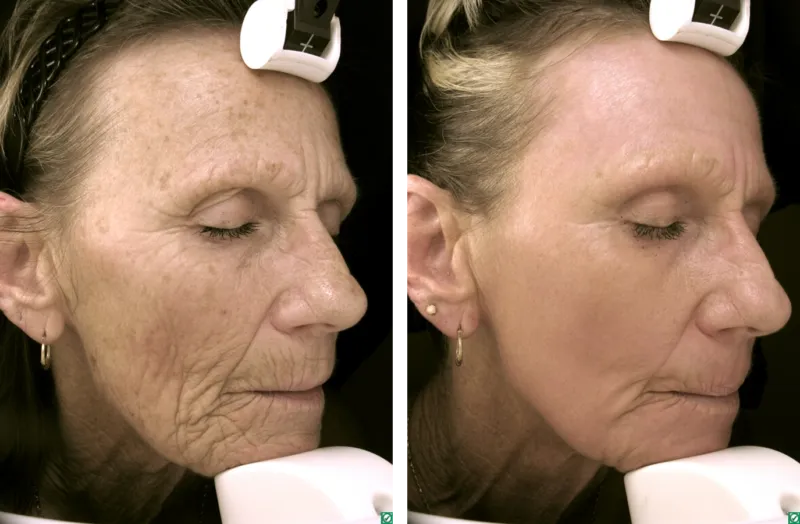 Deep Laser Resurfacing