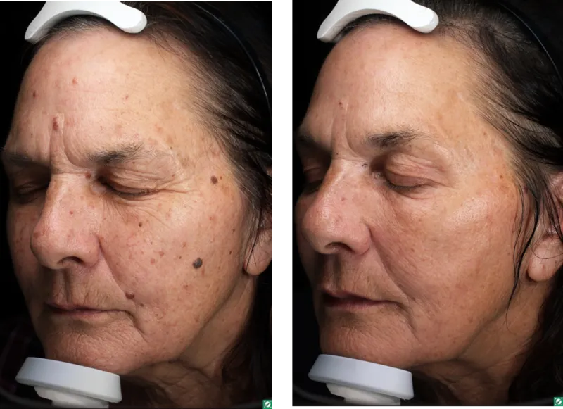 BBL Phototherapy with Halo & Lesion Ablation