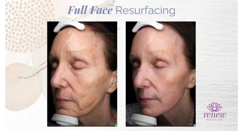 Full face resurfacing with laser peel
