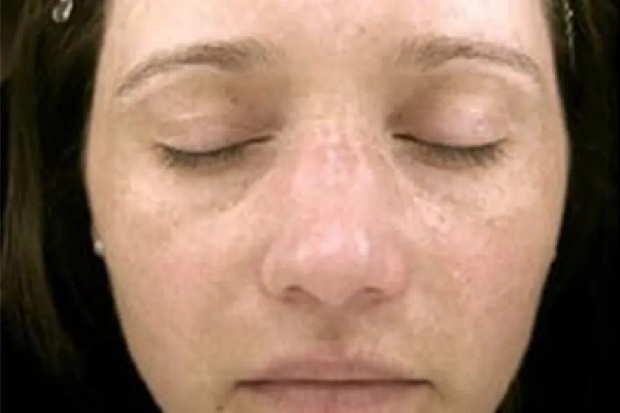 Profractional and Phototherapy