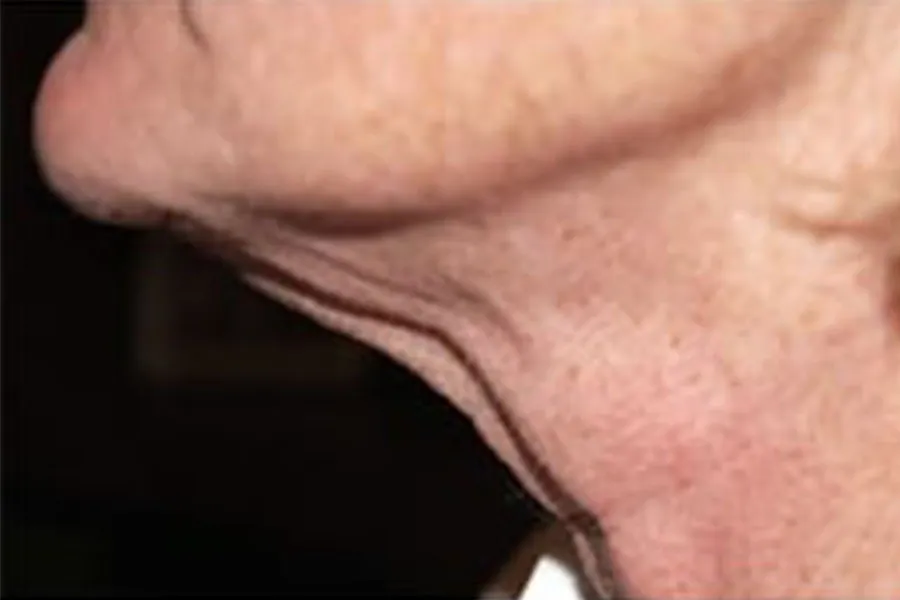 SkinTyte 2