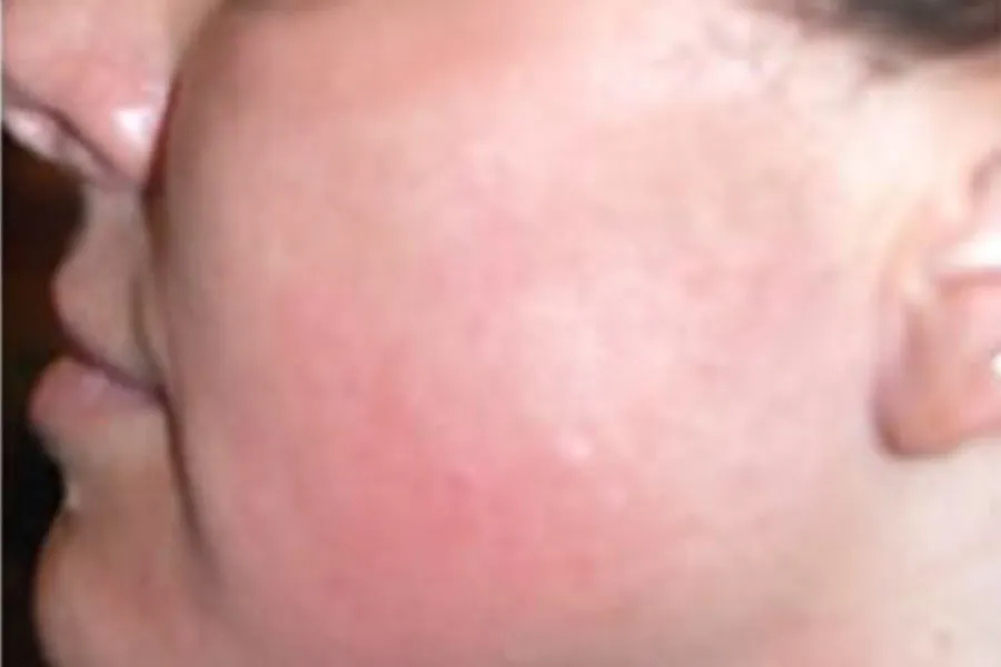 SkinTyte