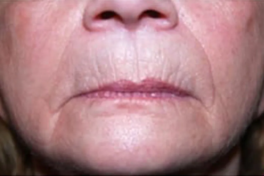 Dermal Fillers 4