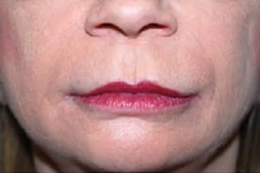 Dermal Fillers