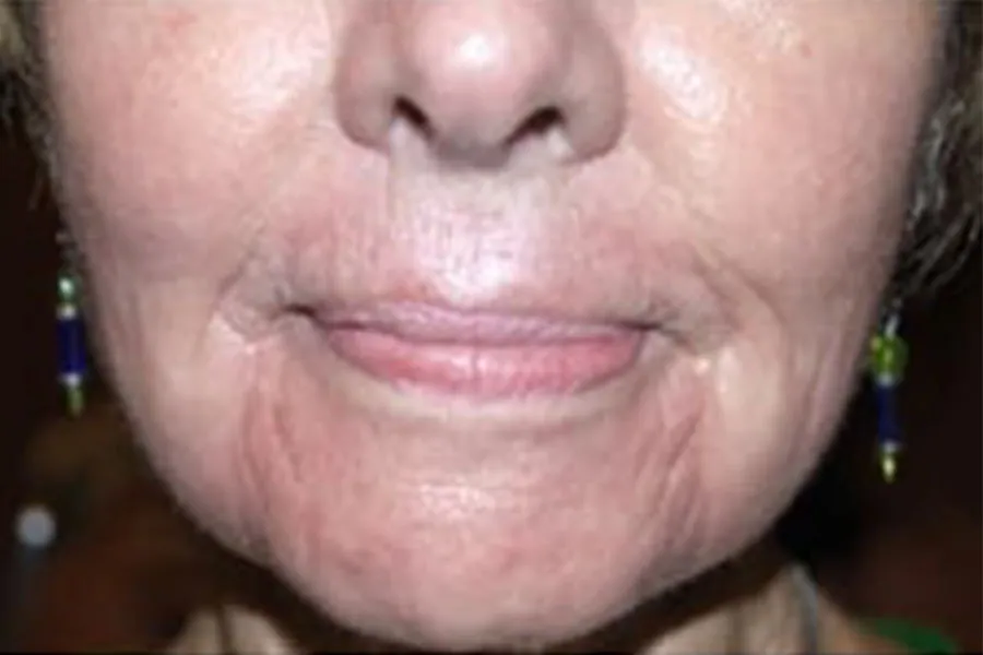 Laser Resurfacing