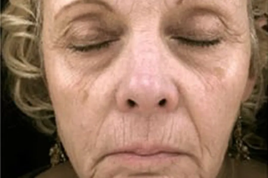 Phototherapy, Laser Resurfacing, Profractional, Botox, and Dermal Filler