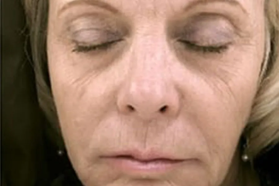Phototherapy, Laser Resurfacing, ProFractional®, Botox, & Dermal Filler