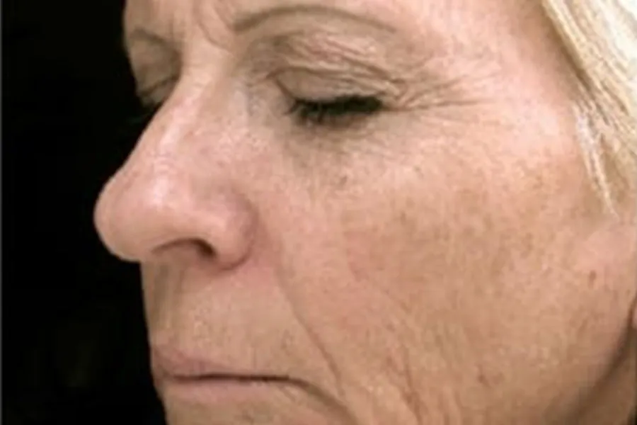 Phototherapy, MicroLaser Peel, Profractional, and Dermal Filler