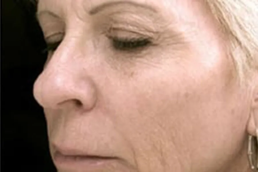 Phototherapy, MicroLaser Peel, ProFractional®, & Dermal Filler