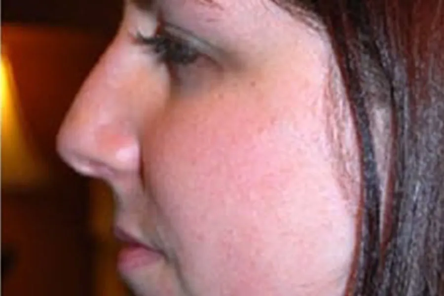 Dermal Fillers