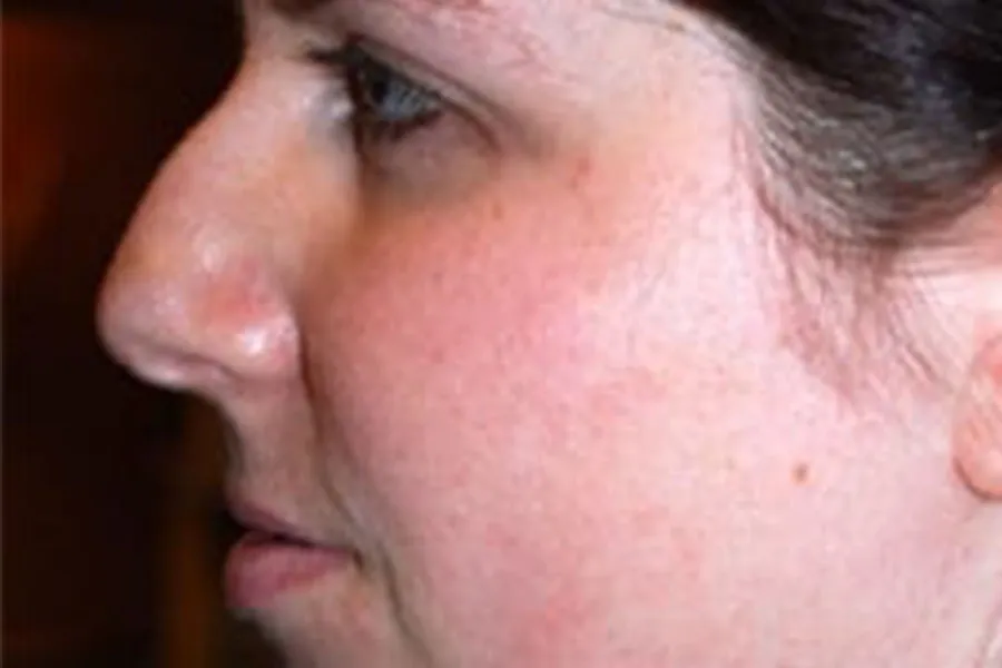 Dermal Fillers 7