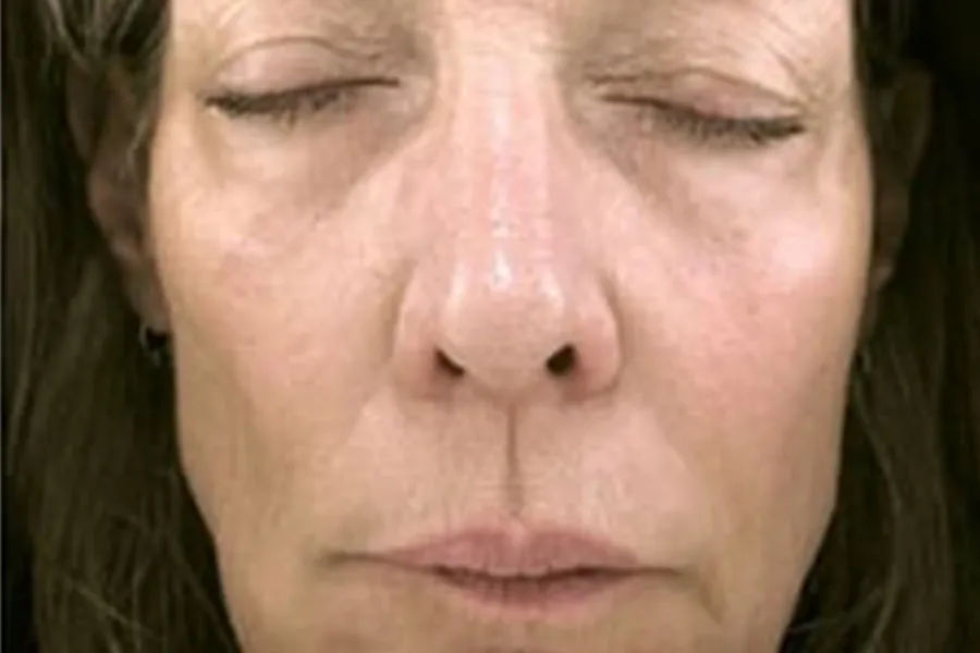 SkinTyte, and Dermal Filler