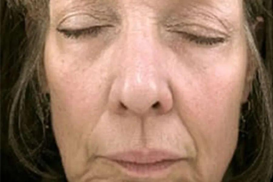 Pelleve, SkinTyte, and Dermal Filler