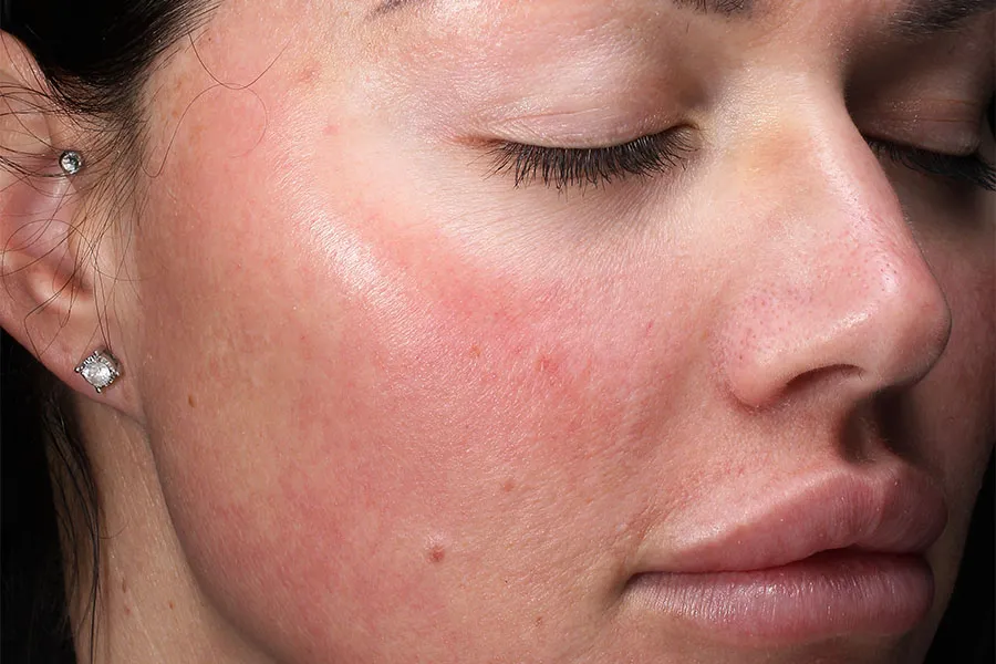 MOXI® Laser - two treatments