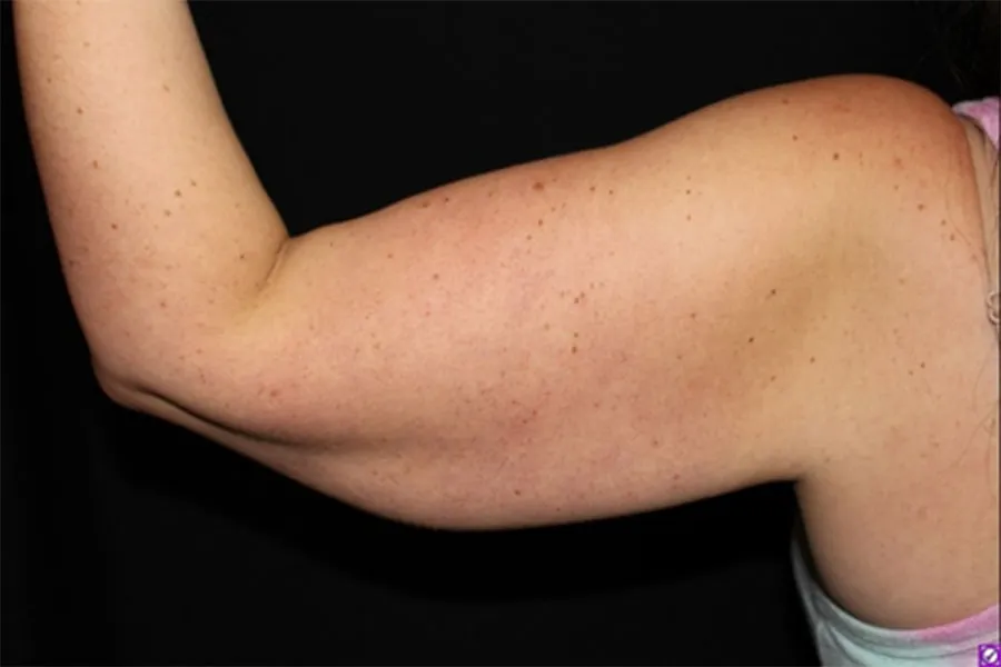 CoolSculpting to Under Arms