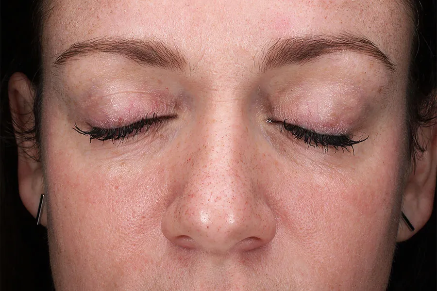 MOXI® Laser