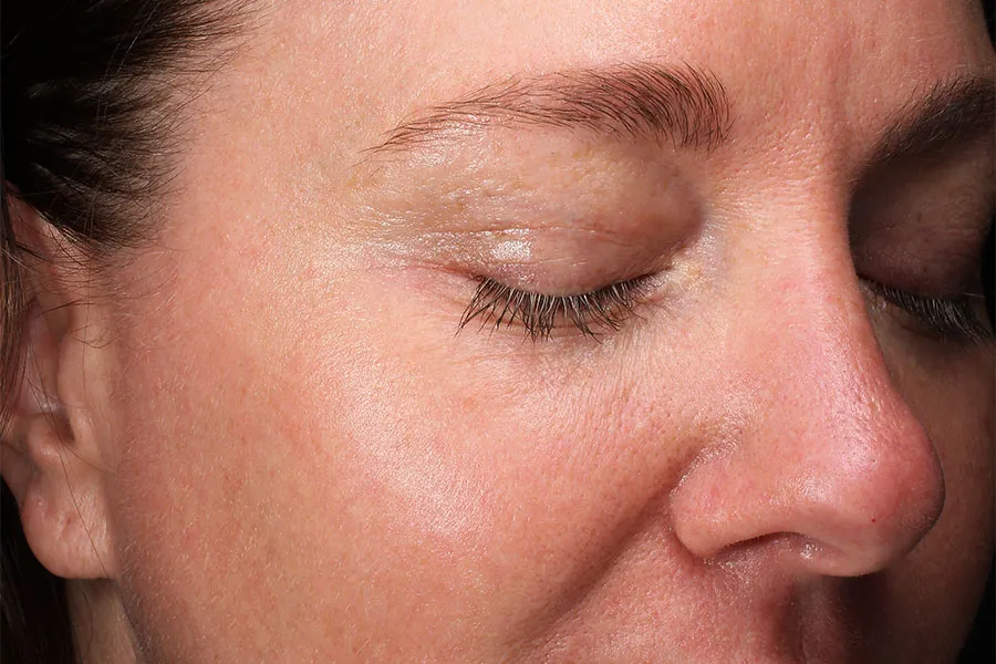 MOXI® Laser