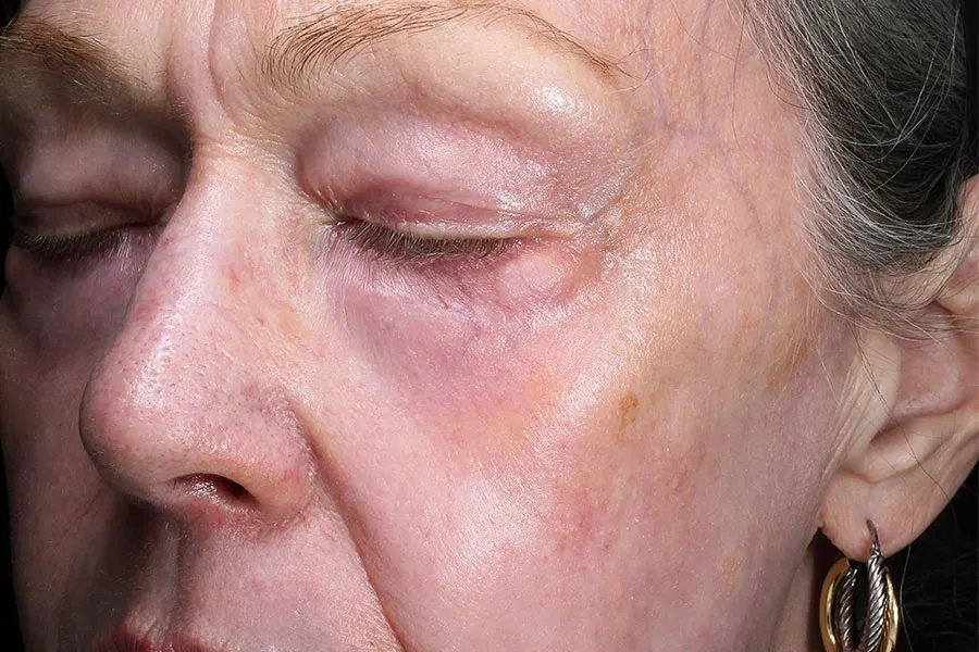 Microlaser Peel