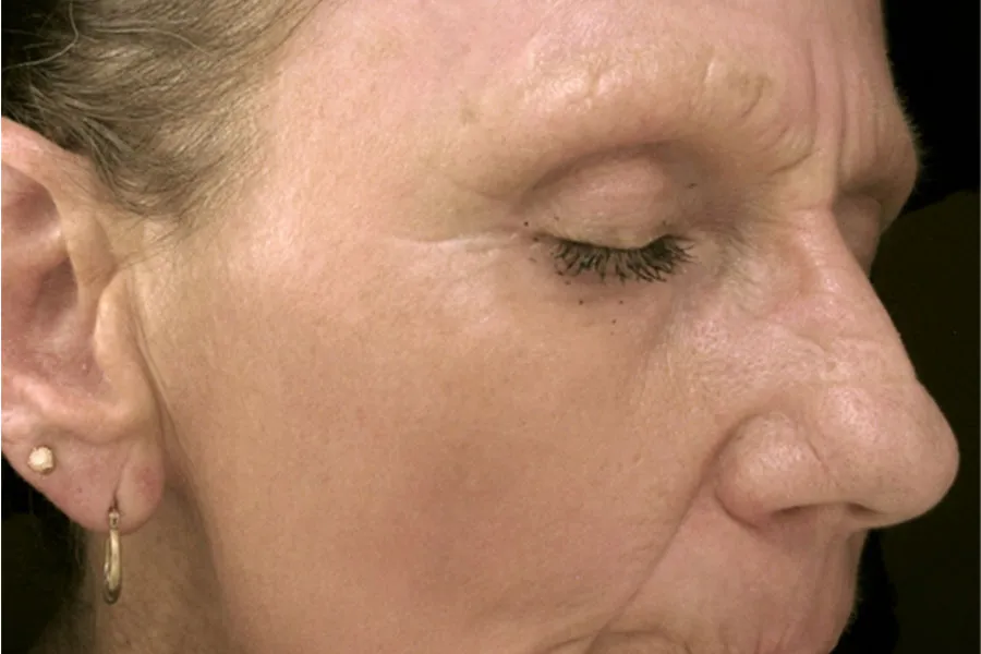 Laser Resurfacing