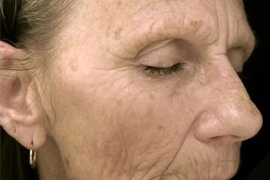 Laser Resurfacing